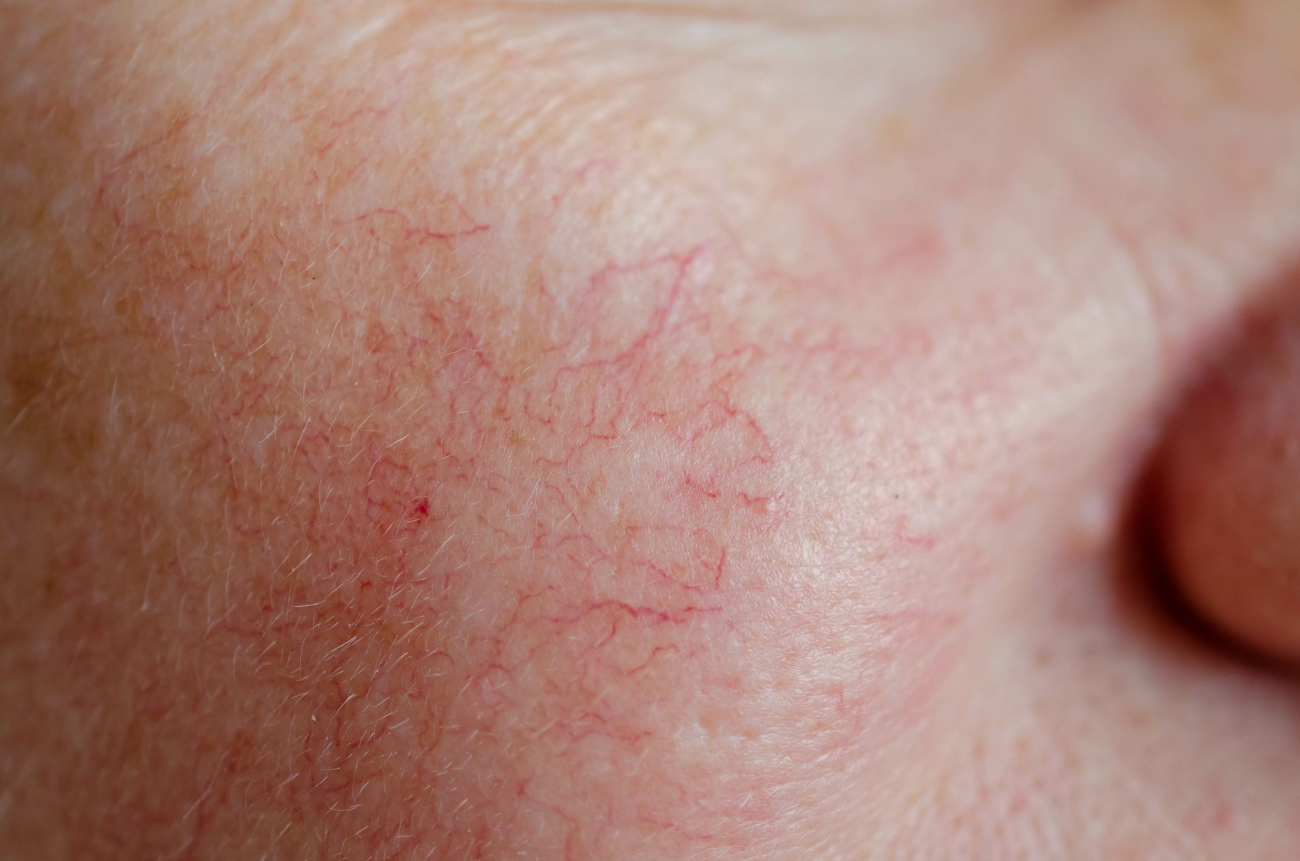 Redness laser treatment Singapore