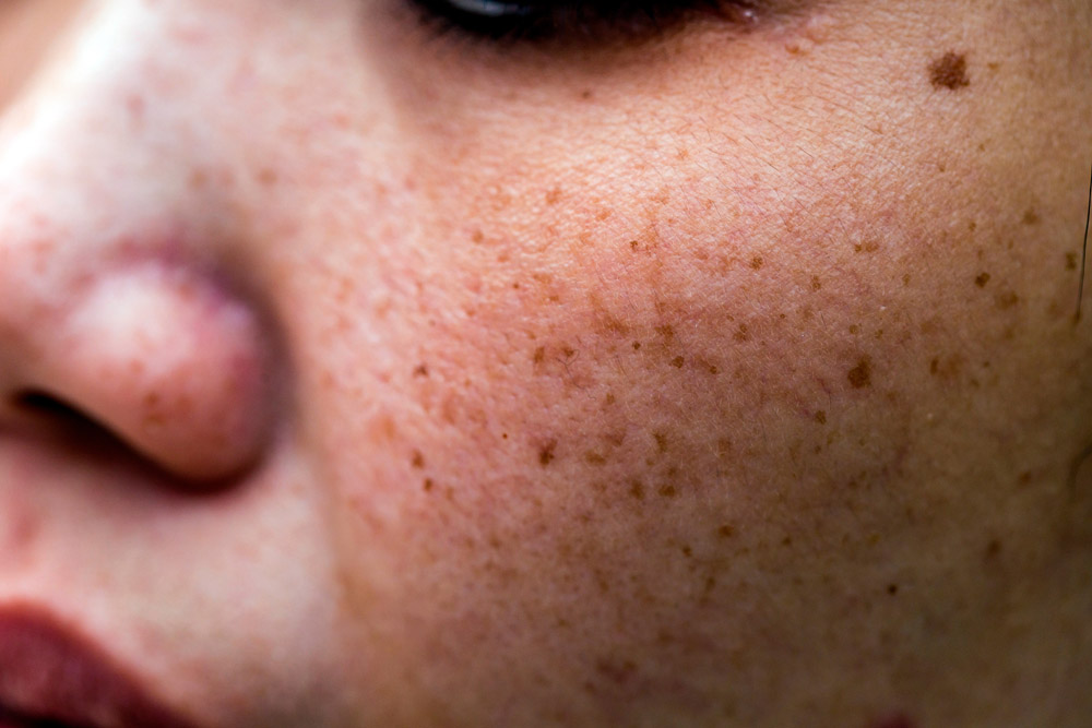 Pigmentation and overall skin condition detail