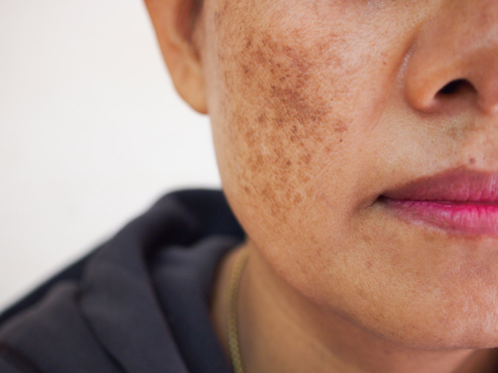 Sun damage laser treatment Singapore