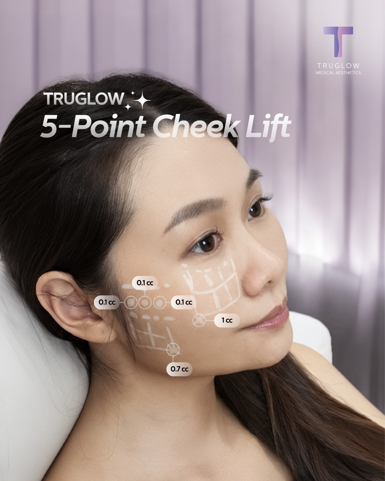 TruGlow 5-Point Cheek Lift diagram showing the five HA filler injection points and volumes used along the cheek